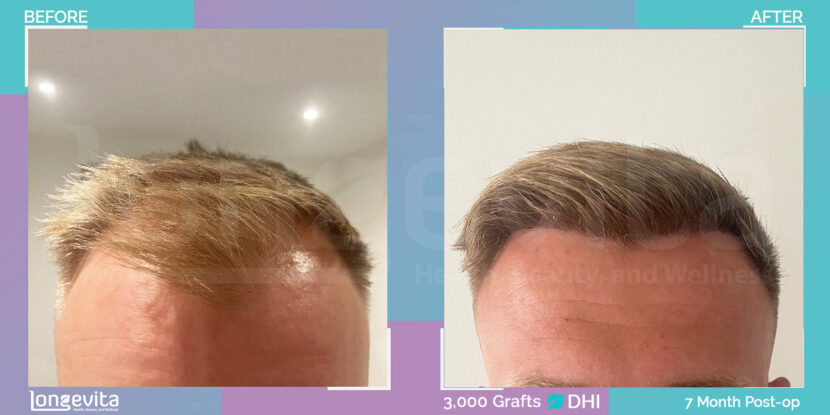 before and after image of a man showing DHI hair transplant results with 3,000 grafts after 7 months