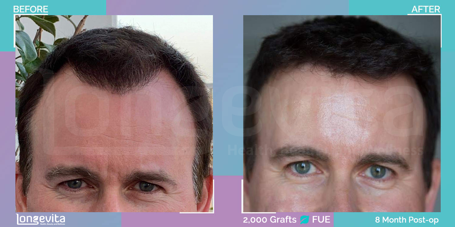before and after image of a man showing FUE hair transplant results with 2,000 grafts after 8 months