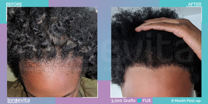 before and after image showing a lowered hairline on afro-textured hair using FUE hair transplant with 3,000 grafts after 8 months