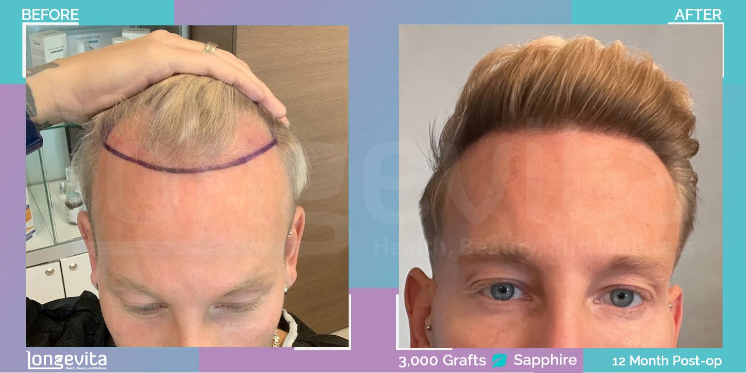 before and after comparison of a man’s hair transplant with 3,000 sapphire grafts showing significant hairline restoration after 12 months