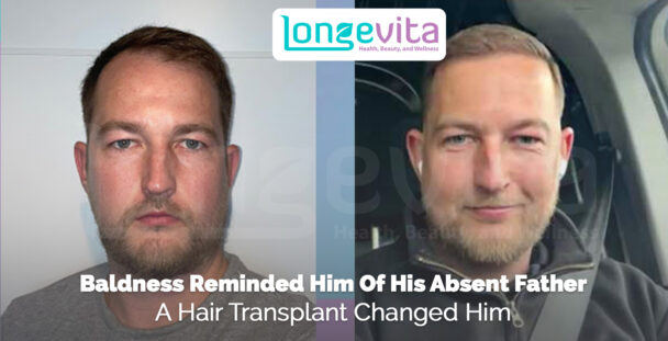 young man after hair transplant smiling with restored hairline