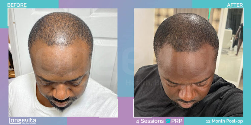 top view of Black male patient showing hair thinning before and fuller hairline after 4 PRP sessions Title: PRP Hair Restoration – 12 Month Results After 4 Sessions