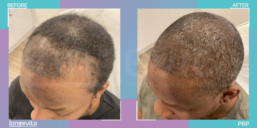 top view of thinning scalp before and fuller hair coverage after PRP treatment Title: PRP Hair Treatment Results – Before and After Comparison