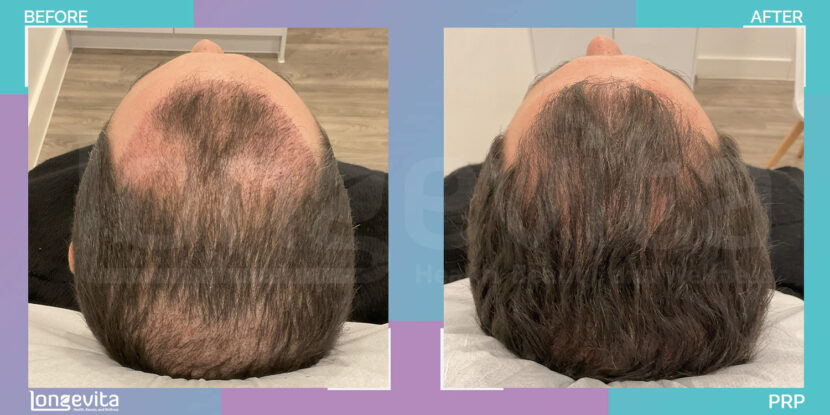 top-down view of male scalp showing hair thinning before and thicker regrowth after PRP treatment