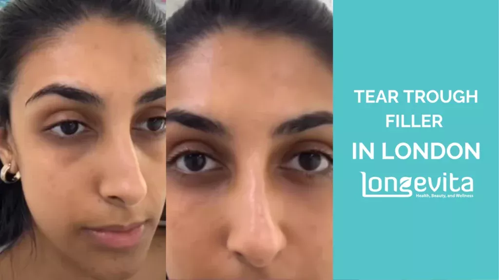 close-up before and after comparison of woman's under-eye area after tear trough filler in London