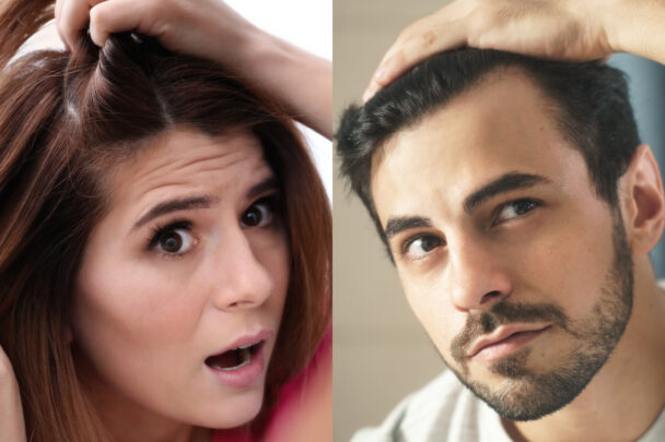 concerned woman and man examining their hairlines and scalp for hair loss