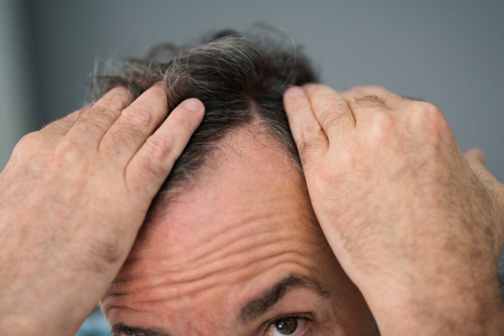 man pulling back hair to reveal receding frontal hairline typical of frontal fibrosing alopecia